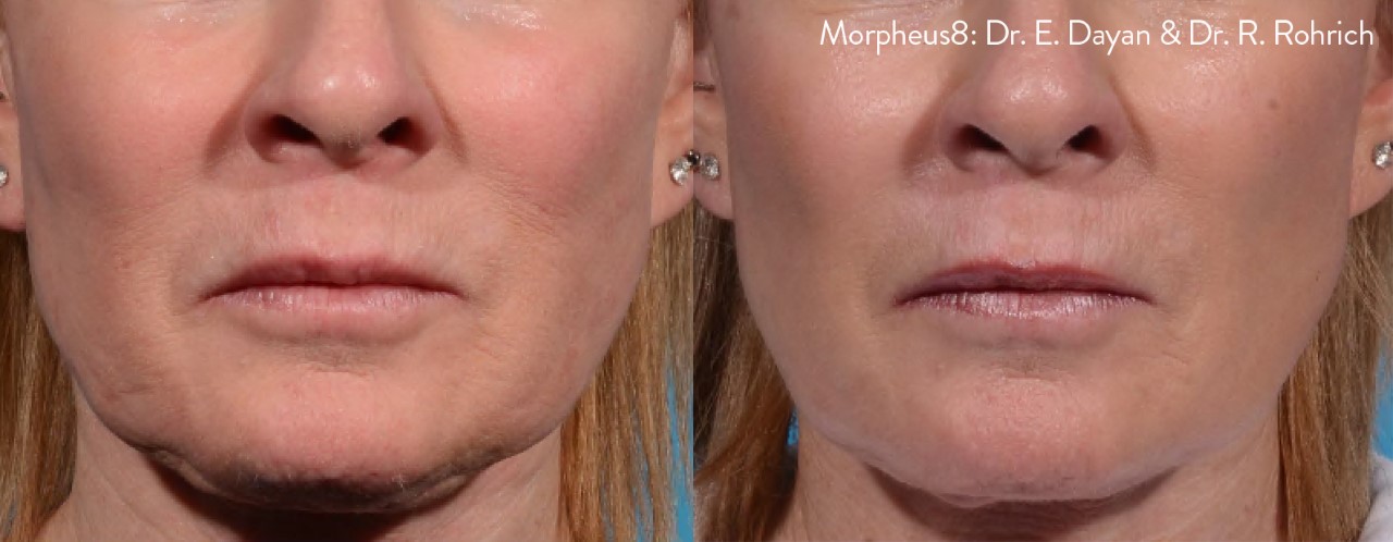 Dr Dev Patel on the benefits of Morpheus8